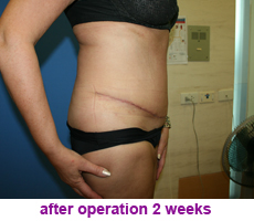 plastic-surgery-tummy-tuck